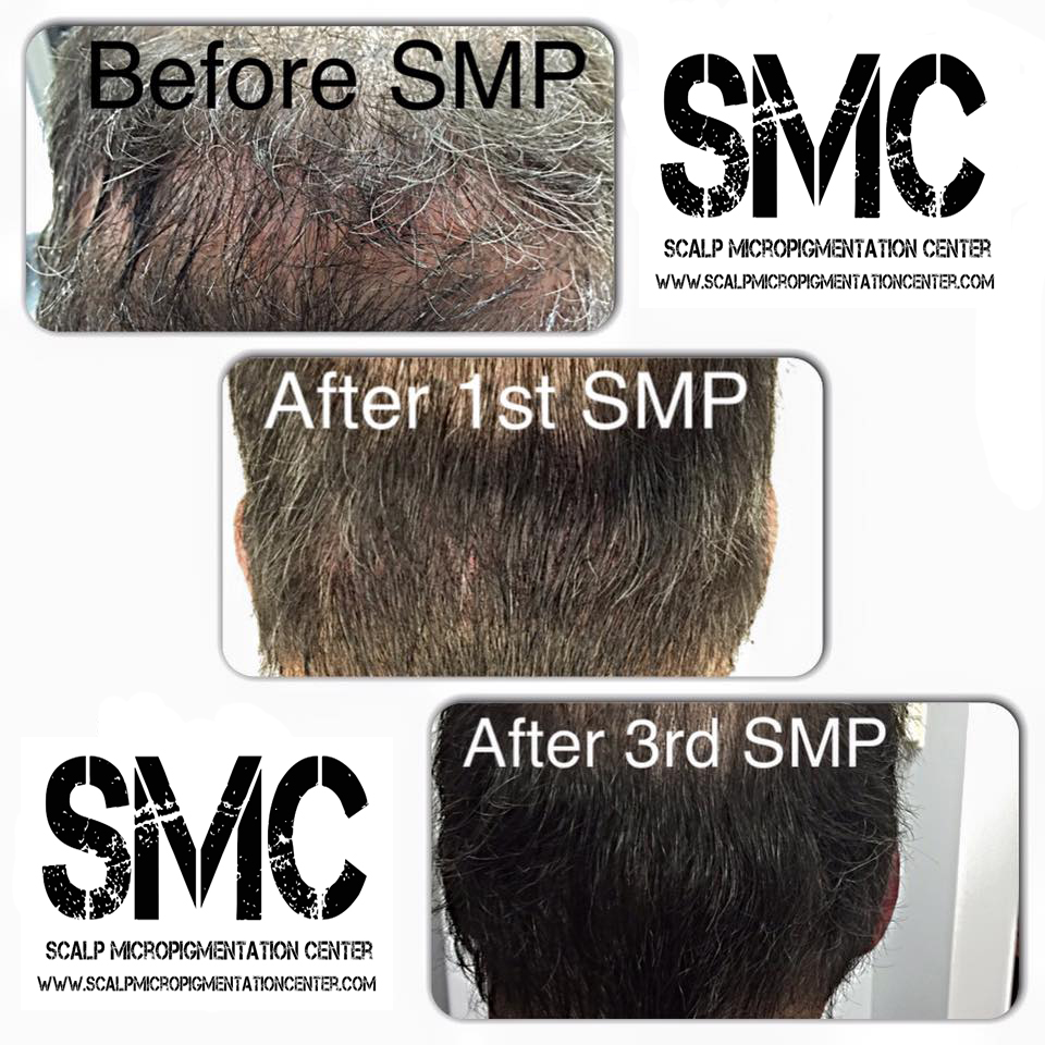 benefit from SMP