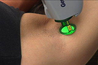 Laser Hair Removal - Combined Alexandrite/YAG laser