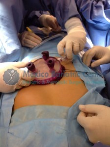 Single-Incision Gastric Sleeve