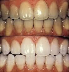 Life-Like Cosmetic Solutions is dedicated to providing quality tooth bleaching products for dentists. 