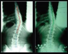Case Studies: Patient A<br />
26 year old, adolescent idiopathic scoliosis