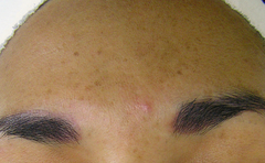 Sun Damage and Acne (Before)