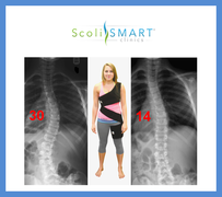 The Scoliosis Activity Suit used in ScoliSMART Clinics