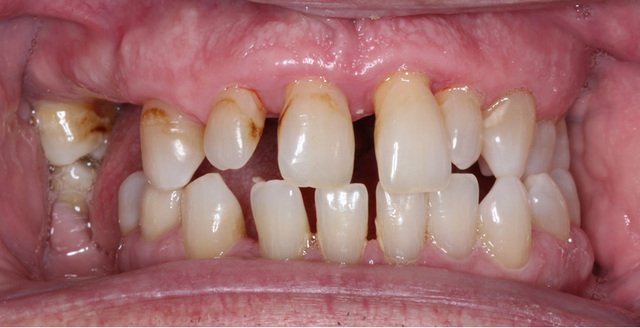 Easing Periodontal Treatment for a Parkinson's Patient