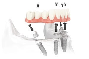 Full Teeth Replacement