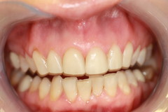 Teeth Whitening Procedure in Aurora, CO