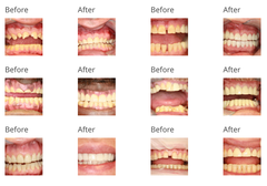 Before and After Images From Dental Procedures at Accord Dental<br />
