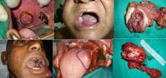 Conservative Resections for oral cavity (mouth) Cancer at Dharamshila Cancer Hospital in India