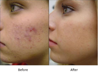 Take Charge in Winning the Battle with Acne