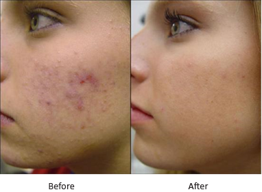 Acne Treatment, Intense Pulsed Light