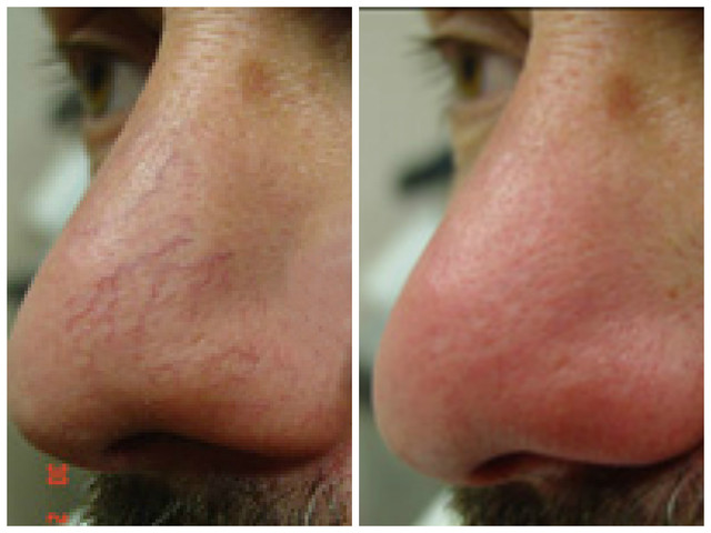 Laser treatments can be very effective for removing spider veins from the face.<br />
