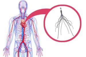 IVC Filter Lawsuits Claim Cooks Filters Could Break and Migrate Contact www.southernmedlaw.com 