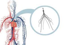 IVC Pulmonary Embolism and Other Dangers Side-Effects Alleged In IVC Filter Lawsuits 