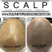 Scalp Micropigmentation Results by Tino Barbone at The Scalp Micropigmentation Center of Toronto.