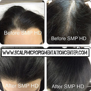 SMP Hair Density Treatment by Tino Barbone at the Scalp Micropigmentation Center of Toronto
