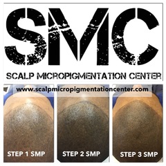 Scalp Micropigmentation Center In Toronto, Ontario Offering The Best Scalp Micropigmentation Treatments in Canada