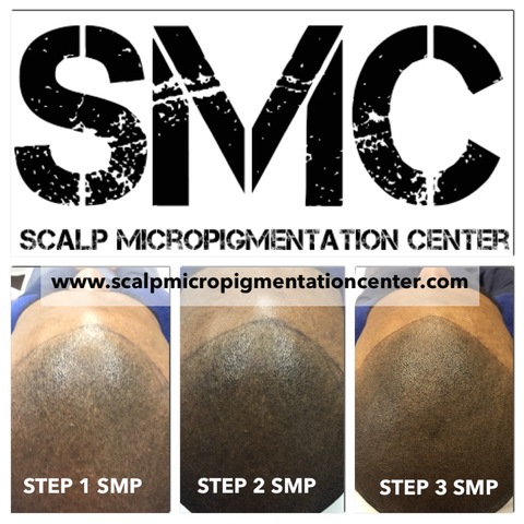 Scalp Micropigmentation Center Results and Reviews of SMP Treatment in Toronto
