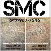 SMP Scar Camouflage results and reviews by Tino Barbone at The Scalp Micropigmentation Center of Toronto, Canada.
