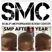 Scalp Micropigmentation Results after 1 Year. Visit The Scalp Micropigmentation Center for more information and reviews.
