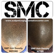 Results and Reviews of Scalp Micropigmentation Hair Density Treatments by Tino Barbone at SMC Toronto.