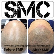 Results and Reviews of Scalp Micropigmentation by Tino Barbone at The Scalp Micropigmentation Center Toronto.