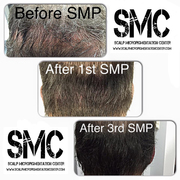 Hair Transplant Scar Camouflage by Tino Barbone at The Scalp Micropigmentation Center of Toronto, Ontario.