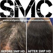 Scalp Micropigmentation Hair Density Results by Tino Barbone at The Scalp Micropigmentation Center.