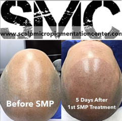 The Scalp Micropigmentation Center of Toronto Offers The Best Scalp Micropigmentation Treatment in Canada