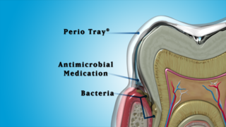 Addressing Antibiotic Resistance in Periodontal Treatment