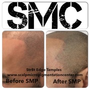 The Best SMP Clinic in Toronto