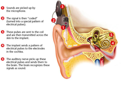 Cochlear implant graphic.