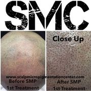 SMP, SMP Hair Density and SMP Scar Camouflage Training, Franchising and Business Opportunities Worldwide.