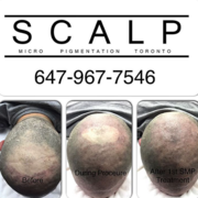 Own your own Scalp Micropigmentation Business by training with the Best SMP Clinic in Canada.  Visit us at www.scalpmicropigmentationcenter.com