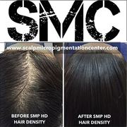 Hair Loss treatment for women with balding or thinning hair. Scalp Micropigmentation for women with thinning hair.