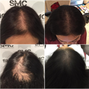 Scalp Micropigmentation Hair Density Treatment for Women. Visit the Best SMP Treatment and Training Clinic.