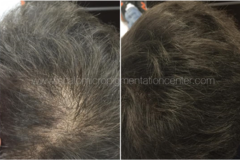 The best scalp micropigmenation Hair Density treatment option for Men with Thin Hair or Hair Transplants.