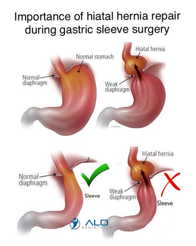 Hietal Hernia Repair during Bariatric Surgery by ALO Bariatrics