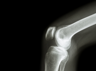 Louisville Orthopedic Dr. Stacie Grossfeld Offers Subchondroplasty Procedures to Patients Suffering from Osteoarthritis, Bone Marrow Edema and Other Joint Degeneration Conditions
