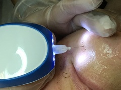 Student Working on Plasma Pen Pro Skin Tightening Client.  Results from Plasma Pen Treatment.