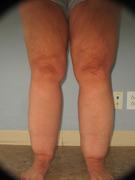 Patient with Lipedema Stage 2, Type 3. This is an example of lipedema which causes abnormal and disproportionate fat accumulation on the legs of  affected women.