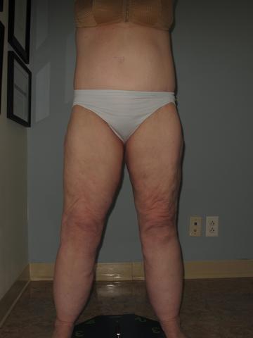 Lipedema with disproportionate accumulation of fat on legs.