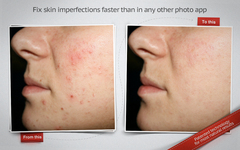 Snapheal - fixing skin imperfections instantly! 