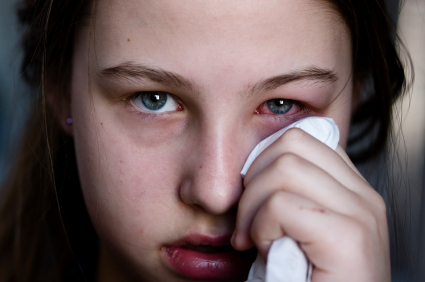 "Pink eye" is most often used to refer to viral conjunctivitis, which affects kids and adults alike.